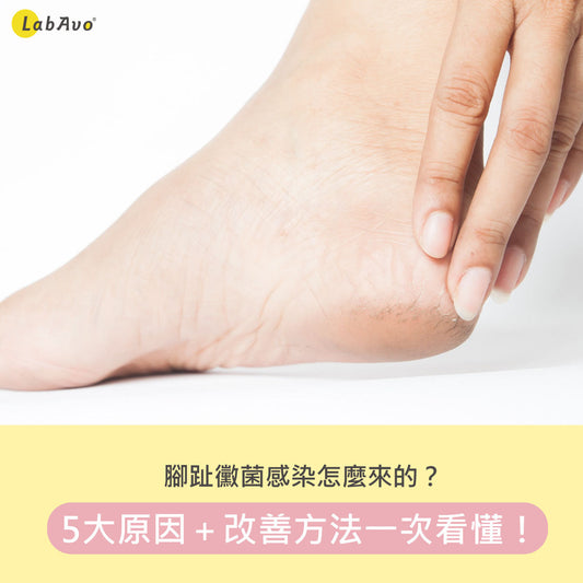 腳趾黴菌感染怎麼辦
